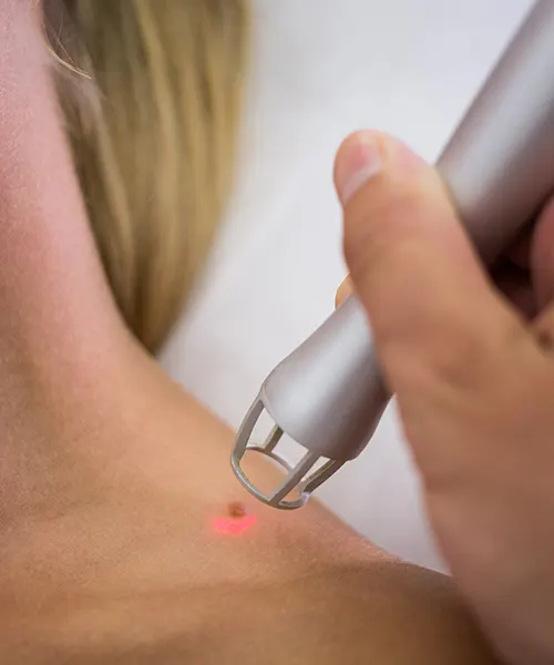 MOLE/SKIN-TAG REMOVAL