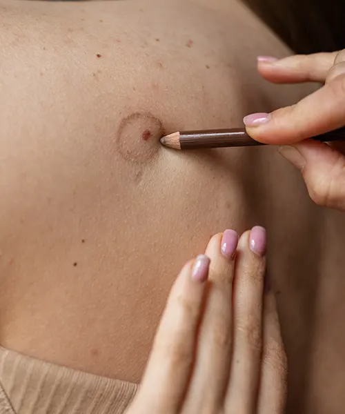 MOLE/SKIN-TAG REMOVAL